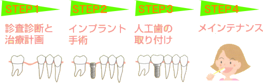 インプラント治療はこのように行います