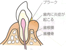 歯肉炎