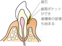 歯周炎