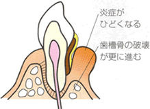 重度歯周炎